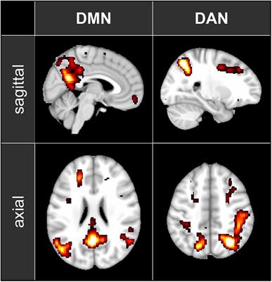 Content-Free Awareness: EEG-fcMRI Correlates of Consciousness as Such in an Expert Meditator